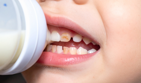 Baby Bottle Tooth Decay How Night-Time Milk Habits Affect Children’s Teeth