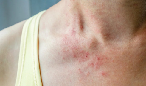 Dust or dust mite sensitivity