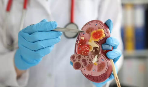 Kidney Stone Prevention Daily Habits That Reduce Your Future Risk