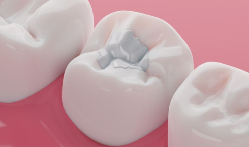 Tooth Filling Materials Silver, White and When Each Option Is Usually Chosen